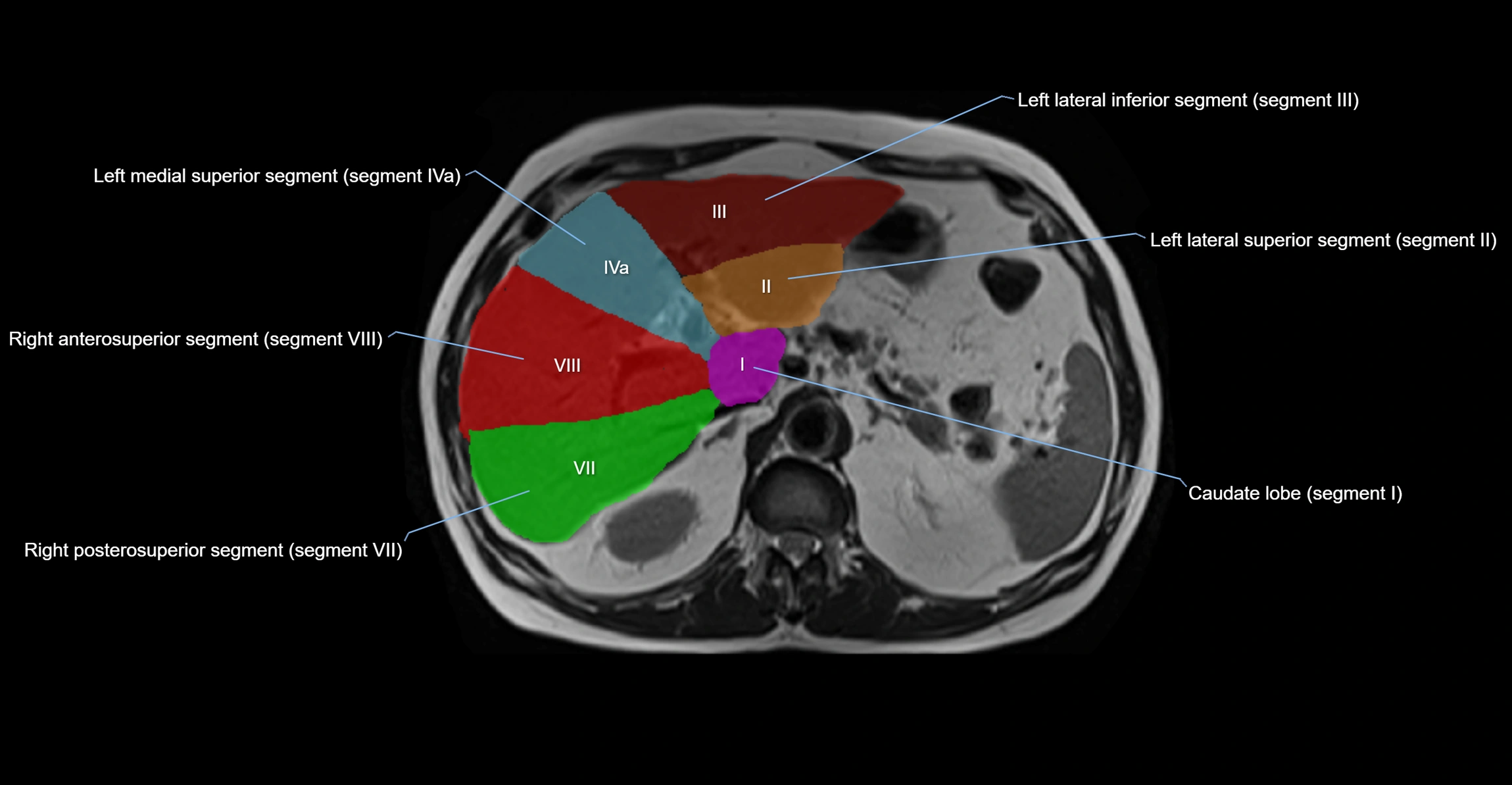 MRI  liver segments anatomy axial cross sectional 3T radiology  image-img-00001-00014.webp